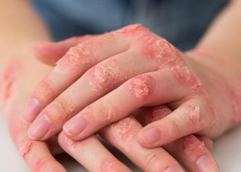 Em quatro meses, AM registra 336 casos confirmados de esporotricose humana, aponta FVS