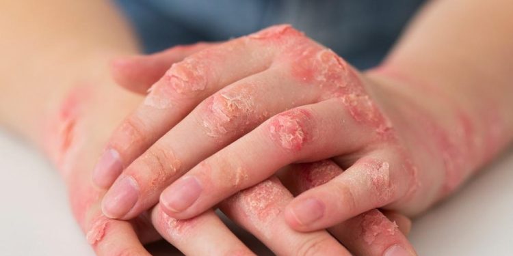 Em quatro meses, AM registra 336 casos confirmados de esporotricose humana, aponta FVS