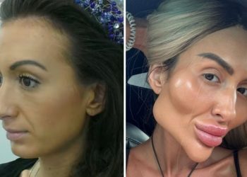 Influencer chama atenção com ‘maiores bochechas do mundo’; veja antes e depois