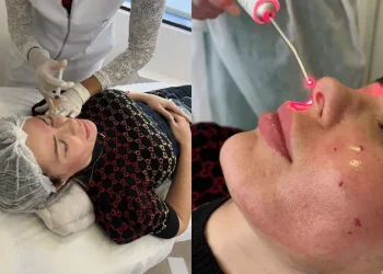 Ju Isen inicia tratamento facial com próprio sangue para atrasar envelhecimento