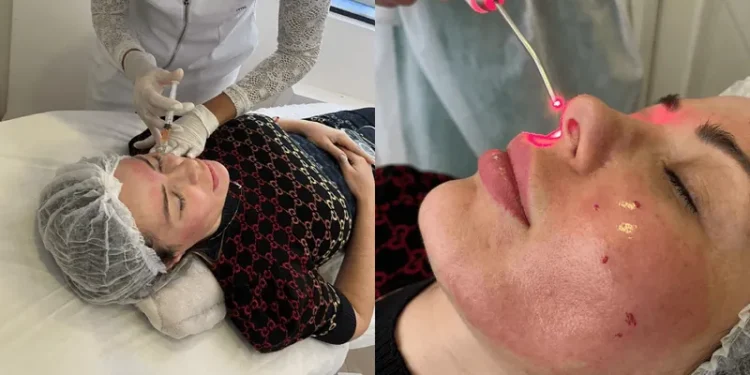 Ju Isen inicia tratamento facial com próprio sangue para atrasar envelhecimento