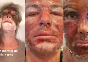 Saiba o que é peeling de fenol, procedimento que jovem morreu depois de fazer