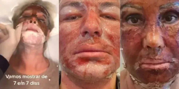 Saiba o que é peeling de fenol, procedimento que jovem morreu depois de fazer