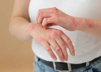 Amazonas registra 1.202 notificações de esporotricose humana