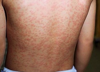 Após cinco anos, Brasil recupera certificado de eliminação do sarampo