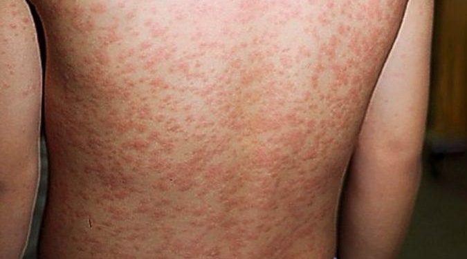 Após cinco anos, Brasil recupera certificado de eliminação do sarampo