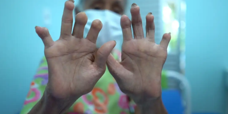 Governo regulamenta pensão para vítimas da hanseníase e filhos separados por internação