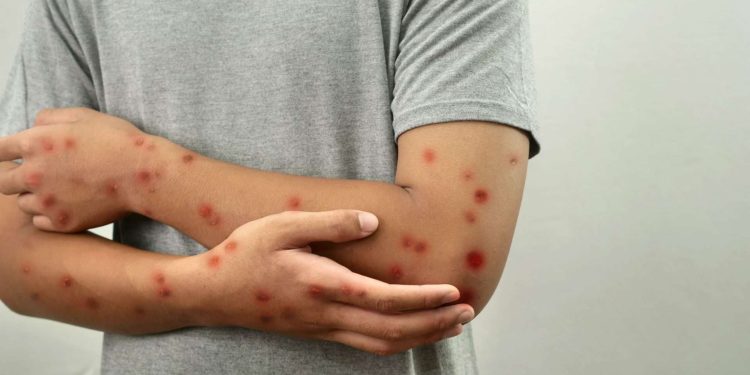 Amazonas tem 15 casos confirmados de Mpox em 2025