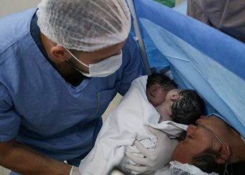 Parto raro de gêmeas siamesas é realizado com sucesso em maternidade do Amazonas
