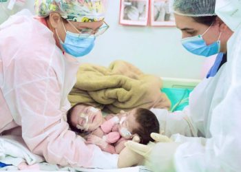 Cirurgia de separação das gêmeas siamesas nascidas no Amazonas é bem-sucedida
