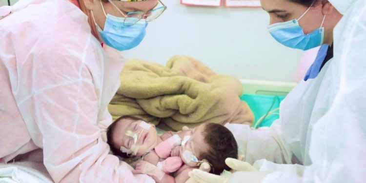 Cirurgia de separação das gêmeas siamesas nascidas no Amazonas é bem-sucedida