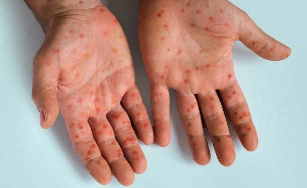 Mpox: 33 casos da doença são confirmados no Amazonas