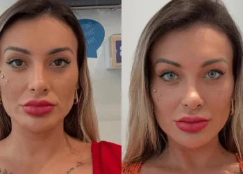 Cirurgia feita por Andressa Urach para mudar cor dos olhos é proibida no Brasil; entenda
