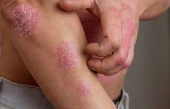 Dia Mundial da Psoríase: Doença afeta muito além do físico, emocional de pacientes também sofre