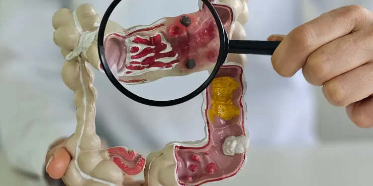 Em 13 anos, doença inflamatória intestinal cresce 5 vezes no Brasil